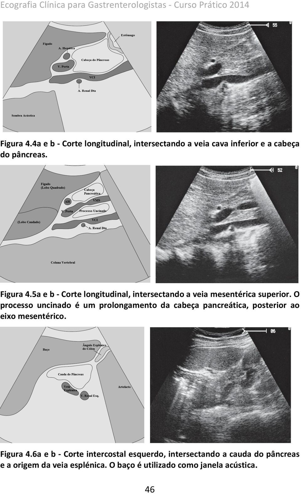 5a e b - Corte longitudinal, intersectando a veia mesentérica superior.