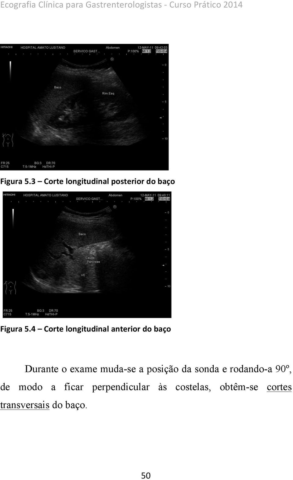 4 Corte longitudinal anterior do baço Durante o exame muda-se a posição da