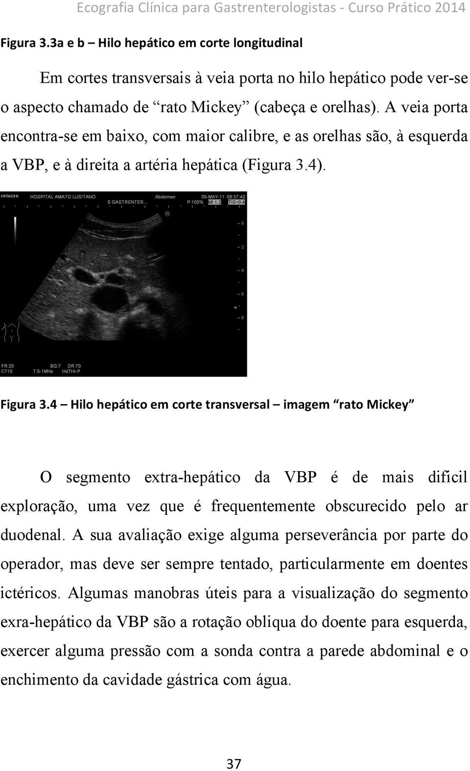 A veia porta encontra-se em baixo, com maior calibre, e as orelhas são, à esquerda a VBP, e à direita a artéria hepática (Figura 3.4). Figura 3.