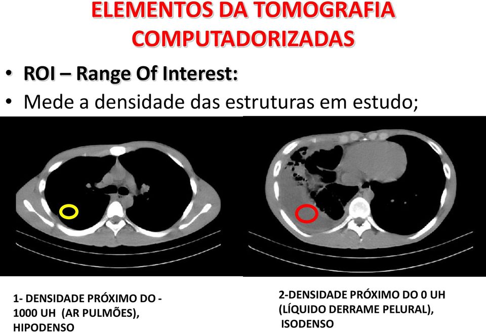 DENSIDADE PRÓXIMO DO - 1000 UH (AR PULMÕES), HIPODENSO