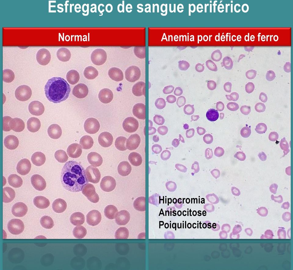 por défice de ferro