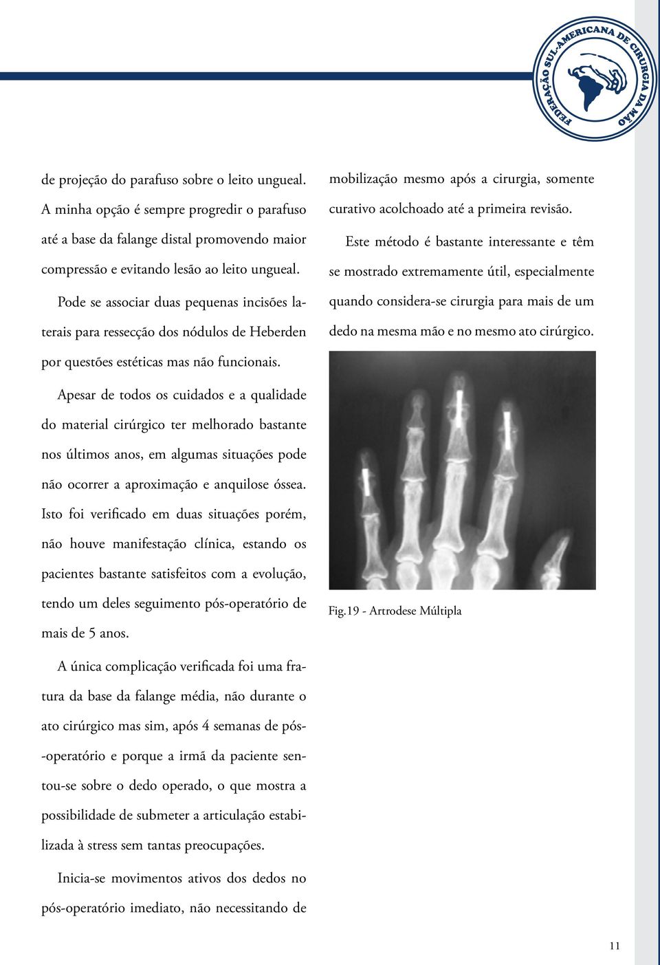 Este método é bastante interessante e têm se mostrado extremamente útil, especialmente quando considera-se cirurgia para mais de um dedo na mesma mão e no mesmo ato cirúrgico.