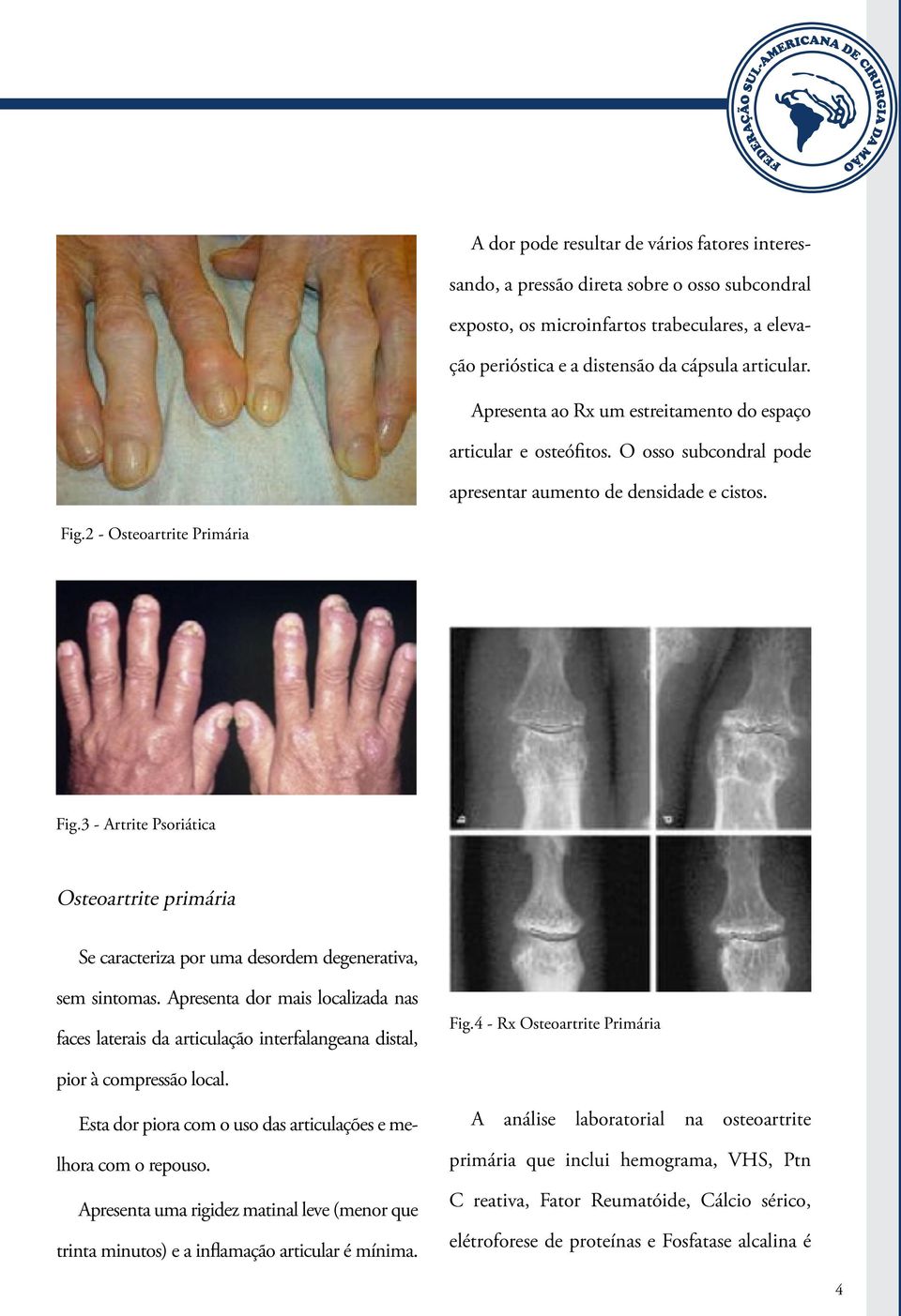 3 - Artrite Psoriática Osteoartrite primária Se caracteriza por uma desordem degenerativa, sem sintomas. Apresenta dor mais localizada nas faces laterais da articulação interfalangeana distal, Fig.