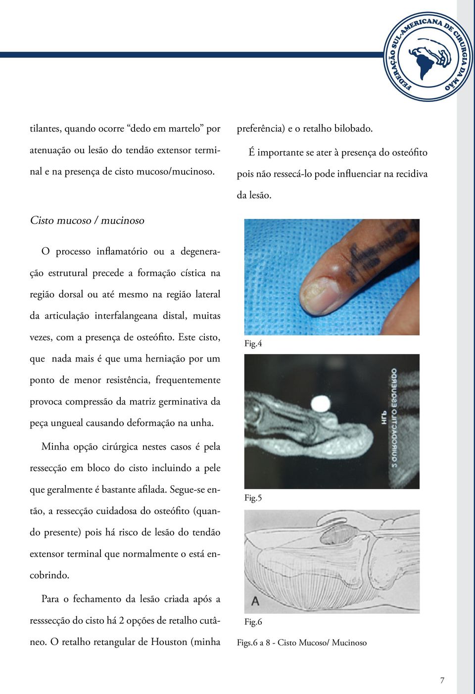 Cisto mucoso / mucinoso O processo inflamatório ou a degeneração estrutural precede a formação cística na região dorsal ou até mesmo na região lateral da articulação interfalangeana distal, muitas