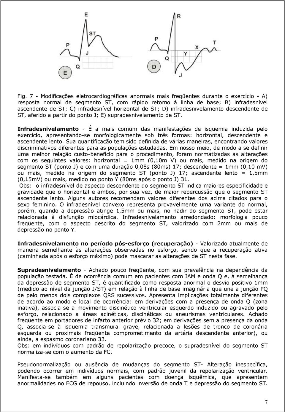 Infradesnivelamento - É a mais comum das manifestações de isquemia induzida pelo exercício, apresentando-se morfologicamente sob três formas: horizontal, descendente e ascendente lento.