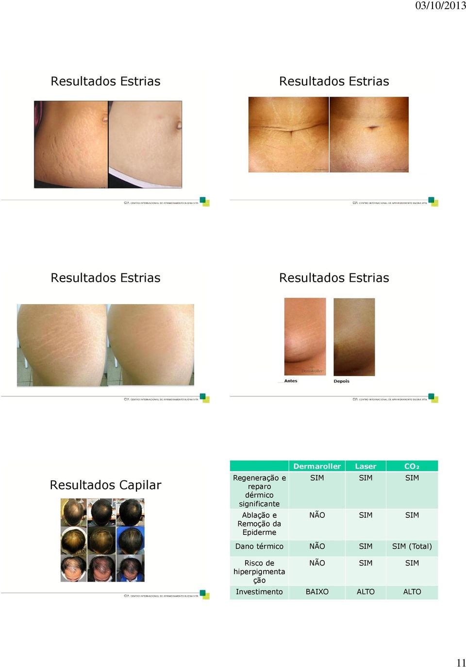 Remoção da Epiderme Laser CO₂ SIM SIM SIM NÃO SIM SIM Dano térmico NÃO SIM