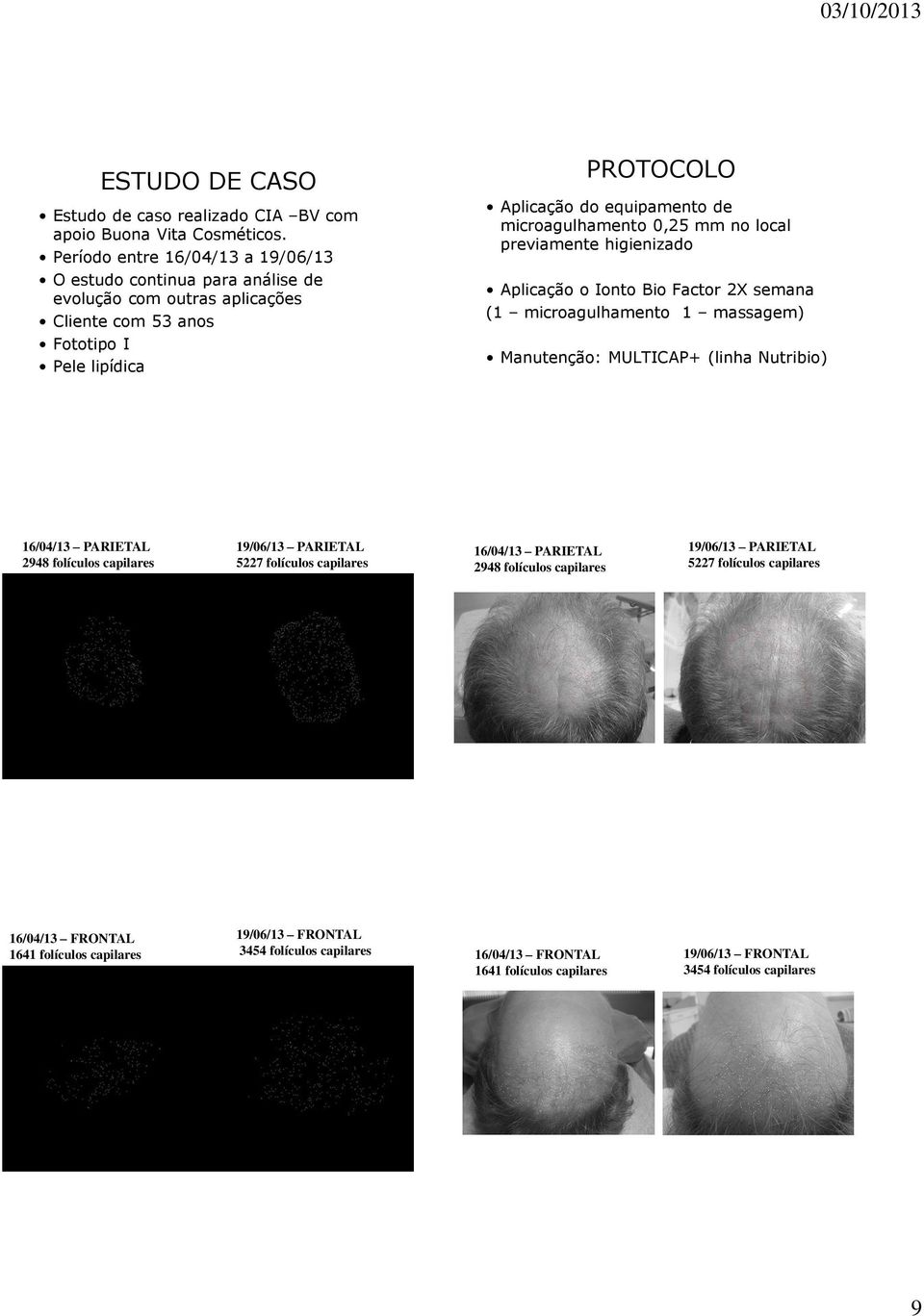 microagulhamento 0,25 mm no local previamente higienizado Aplicação o Ionto Bio Factor 2X semana (1 microagulhamento 1 massagem) Manutenção: MULTICAP+ (linha Nutribio) 16/04/13 PARIETAL 2948