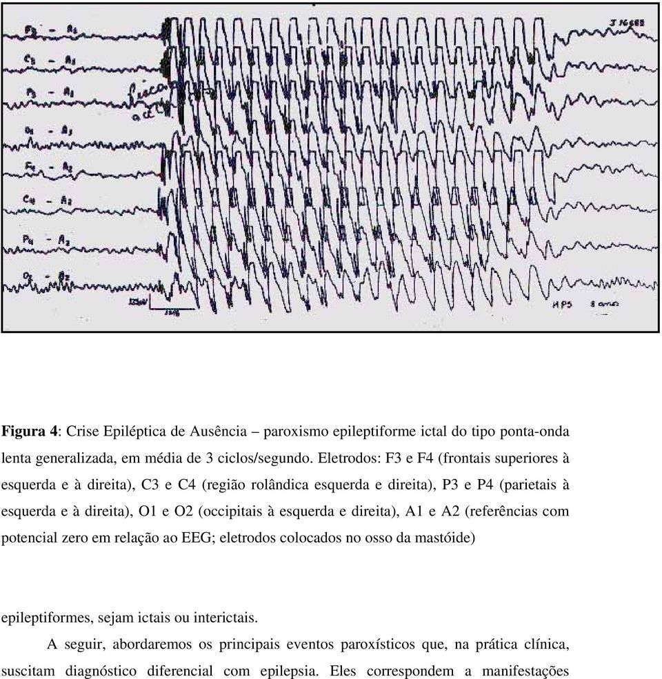 O2 (occipitais à esquerda e direita), A1 e A2 (referências com potencial zero em relação ao EEG; eletrodos colocados no osso da mastóide) epileptiformes, sejam