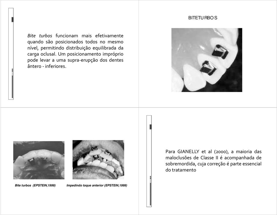 Um posicionamento impróprio pode levar a uma supra erupção dos dentes ântero inferiores.