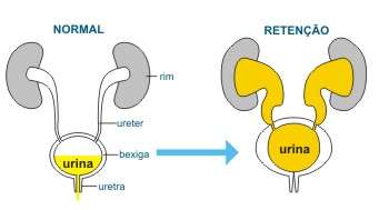 RETENÇÃO URINÁRIA A retenção urinária é um problema caracterizado pela incapacidade da bexiga de se esvaziar completamente.