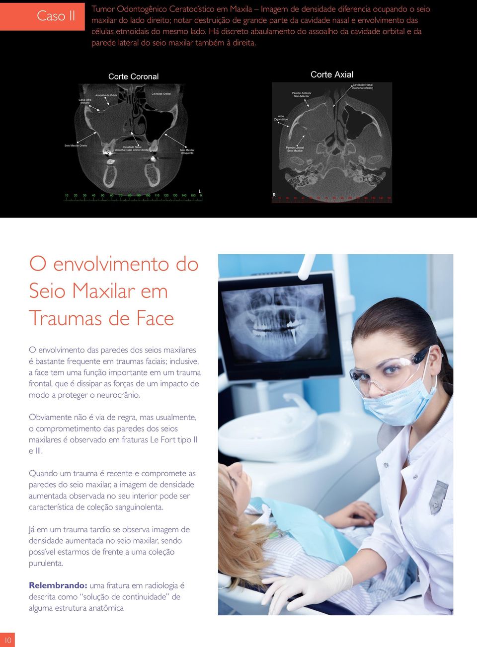 O envolvimento do Seio Maxilar em Traumas de Face O envolvimento das paredes dos seios maxilares é bastante frequente em traumas faciais; inclusive, a face tem uma função importante em um trauma