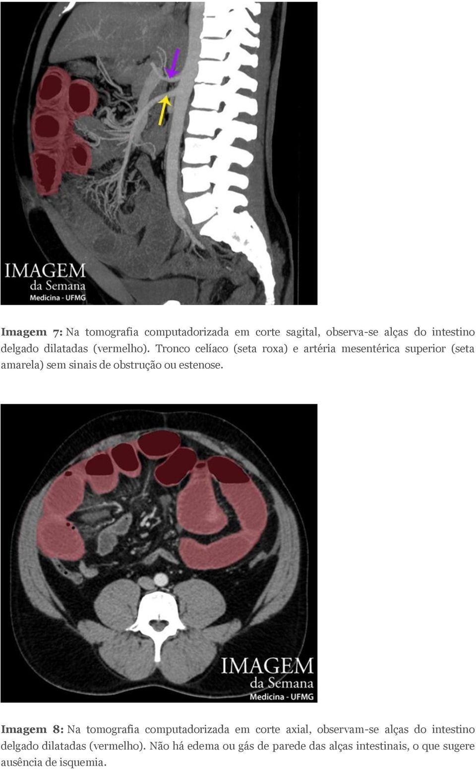 Tronco celíaco (seta roxa) e artéria mesentérica superior (seta amarela) sem sinais de obstrução ou