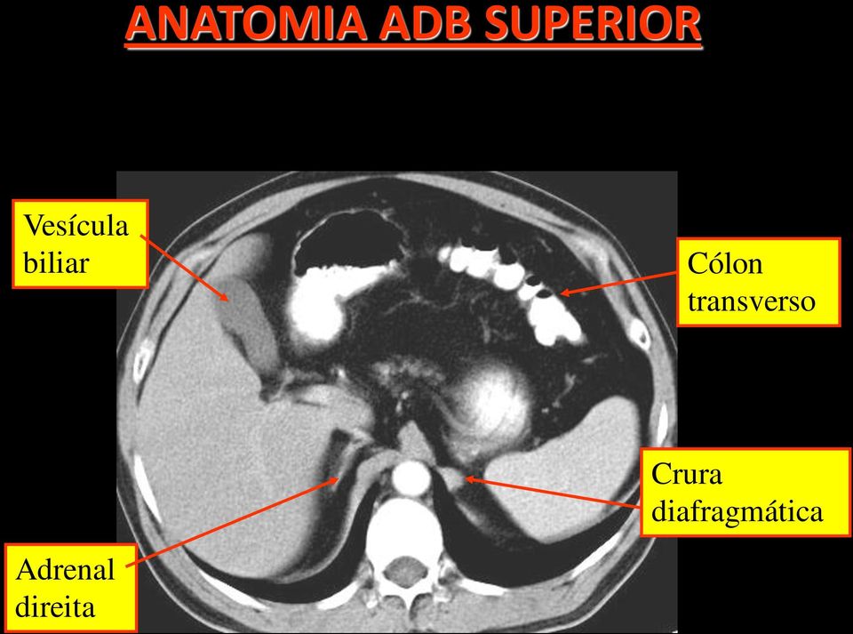 transverso Adrenal