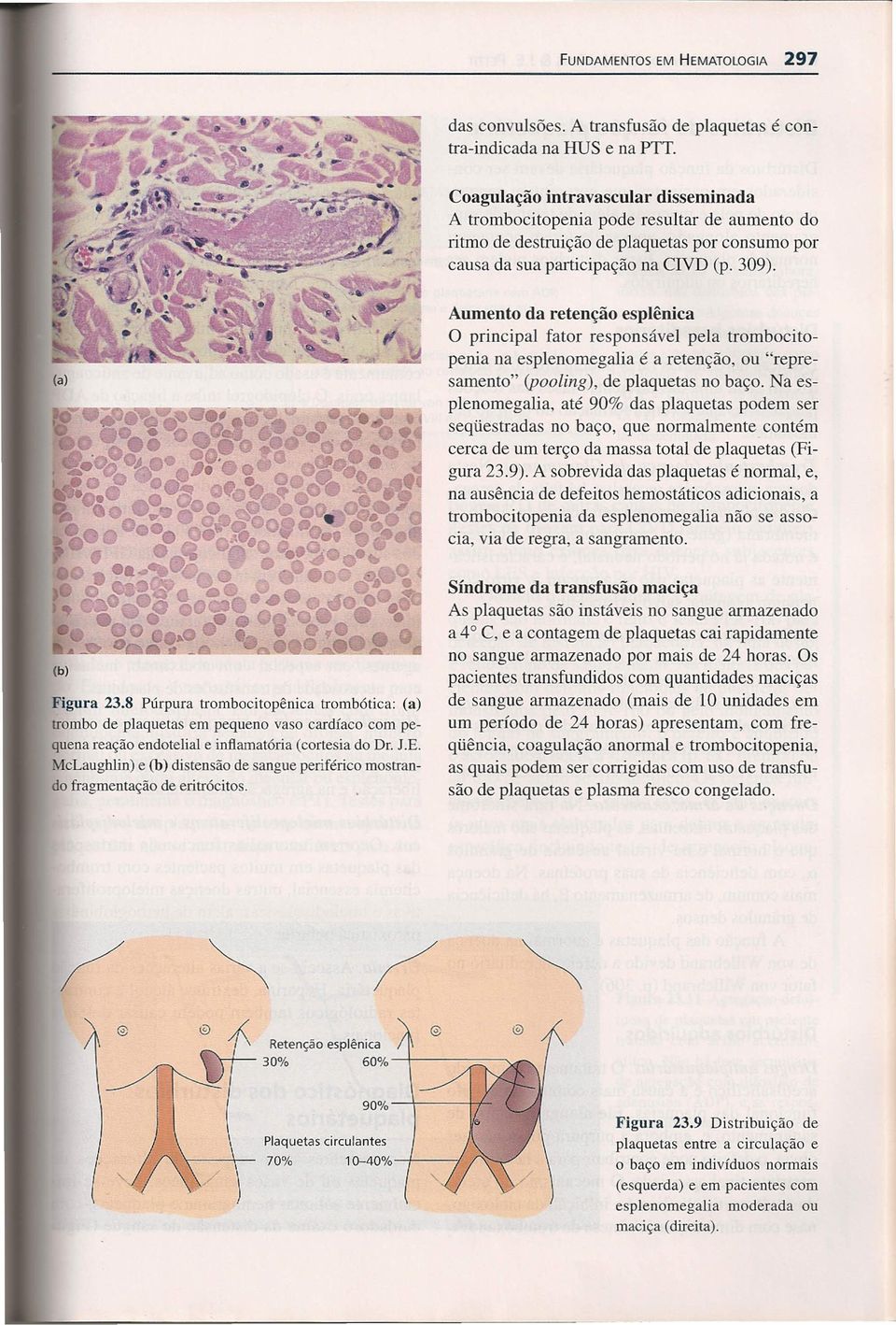 (a) Aumento da retenção esplênica principal fator responsável pela trornbocitopenia na esplenomegalia é a retenção, ou "represamento" (pooling), de plaquetas no baço.