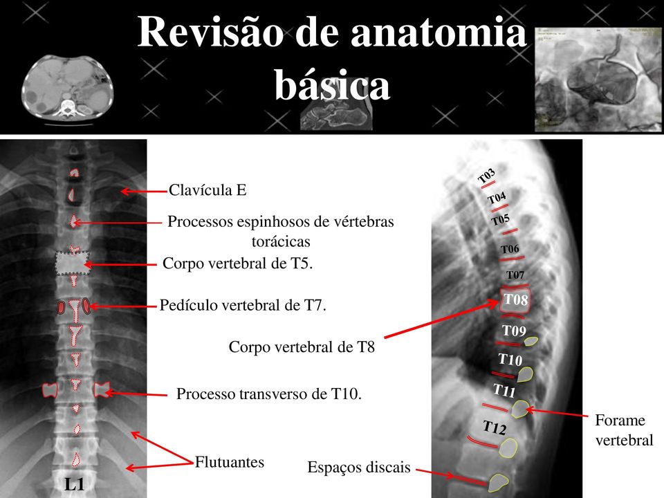 T07 Pedículo vertebral de T7.