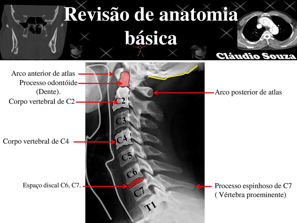 Corpo vertebral de C2 Arco posterior de atlas Corpo
