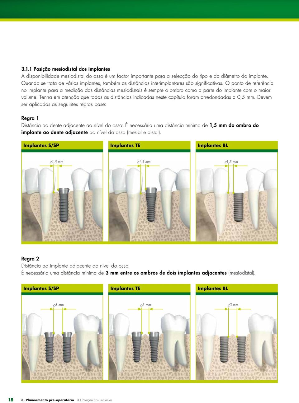 O ponto de referência no implante para a medição das distâncias mesiodistais é sempre o ombro como a parte do implante com o maior volume.