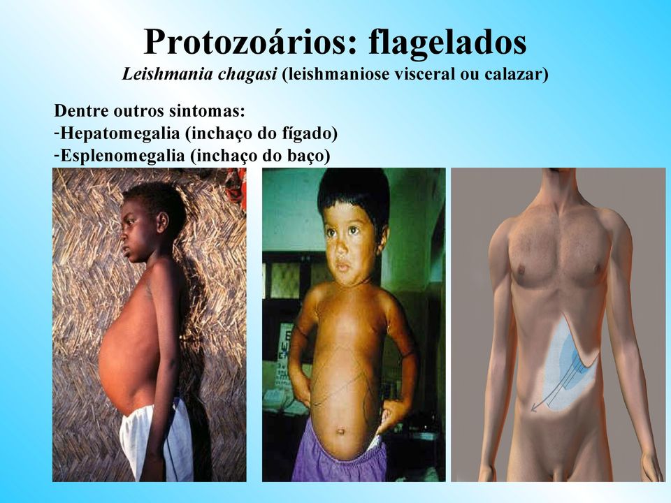 Dentre outros sintomas: -Hepatomegalia