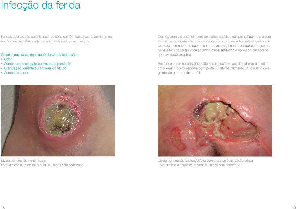 satélites na pele adjacente à úlcera são sinais de disseminação da infecção aos tecidos subjacentes.