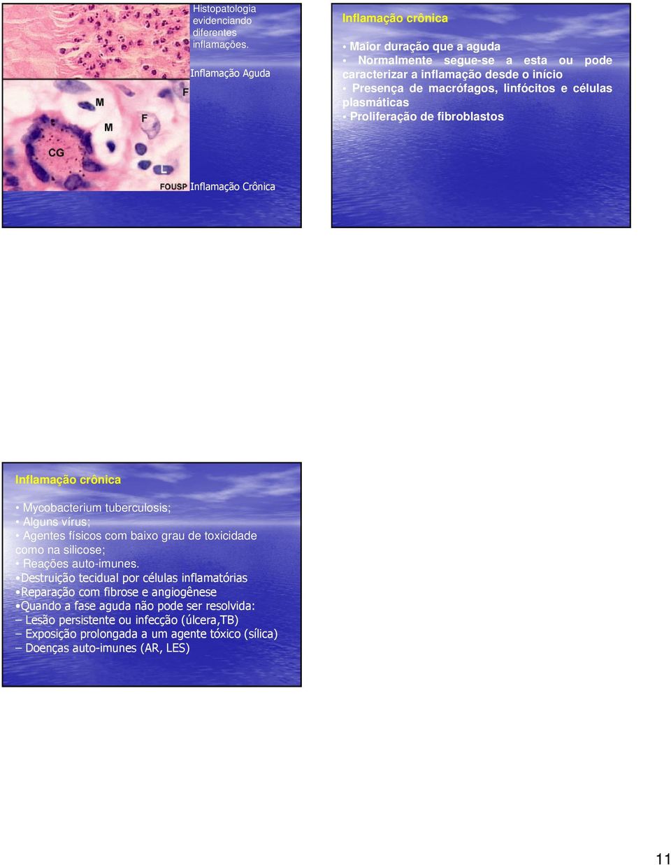 linfócitos e células plasmáticas Proliferação de fibroblastos Inflamação Crônica Inflamação crônica Mycobacterium tuberculosis; Alguns vírus; Agentes físicos com baixo grau