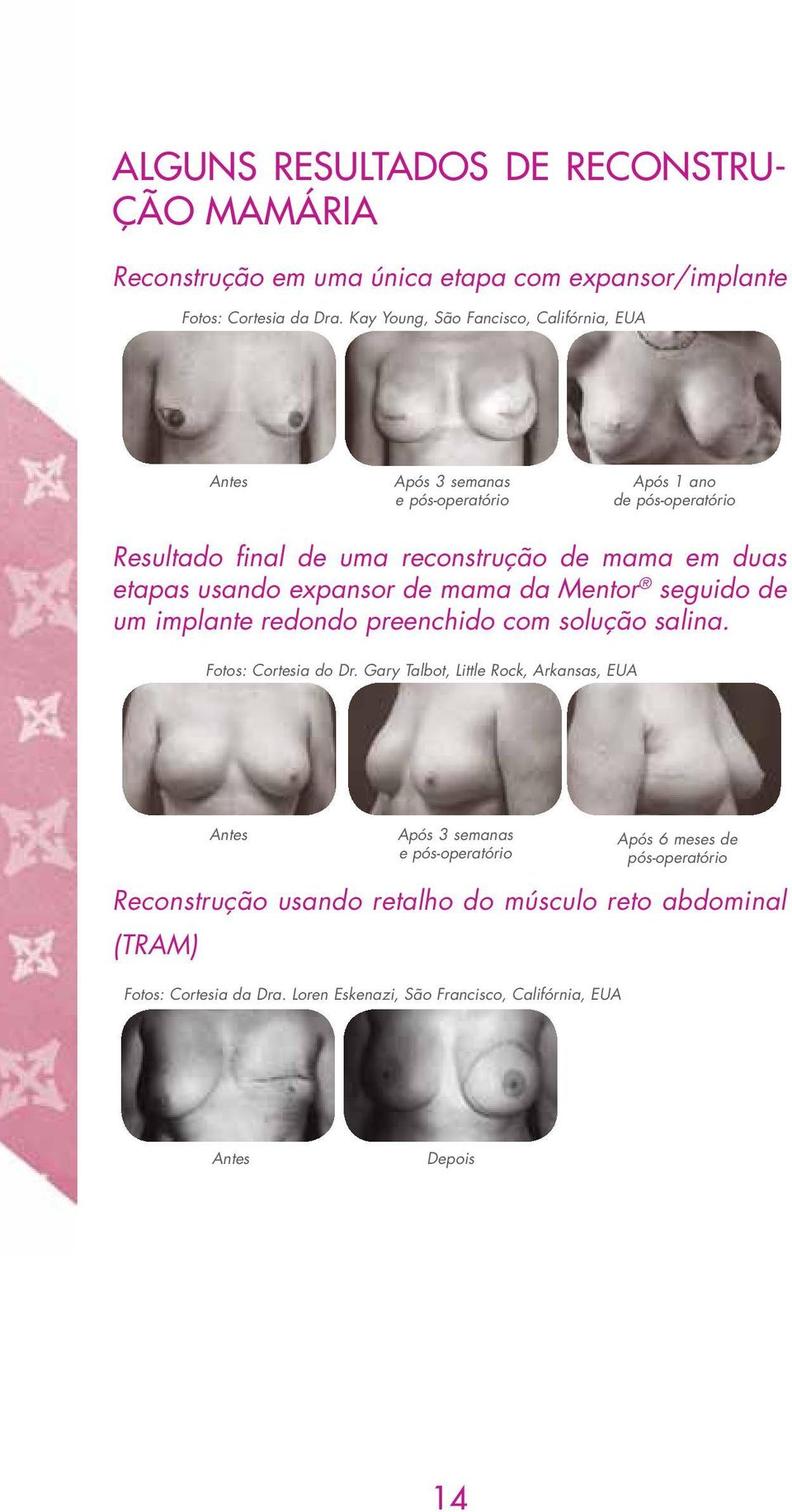 etapas usando expansor de mama da Mentor seguido de um implante redondo preenchido com solução salina. Fotos: Cortesia do Dr.