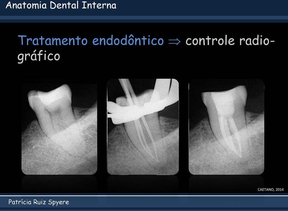 endodôntico controle