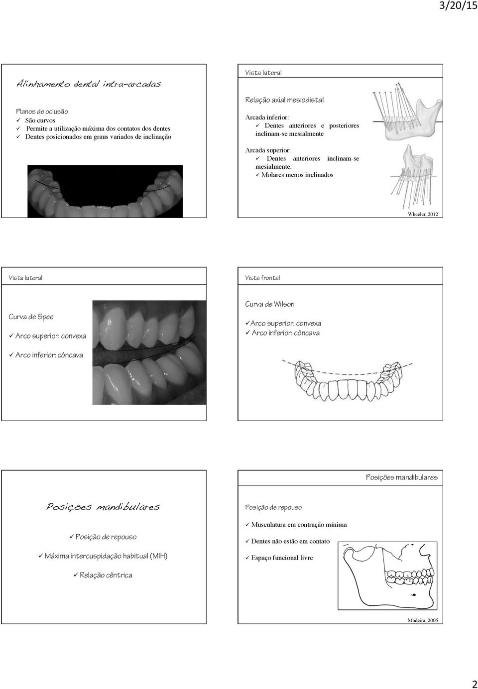 Dentes anteriores e posteriores inclinam-se mesialmente Arcada superior:! Dentes anteriores inclinam-se mesialmente.