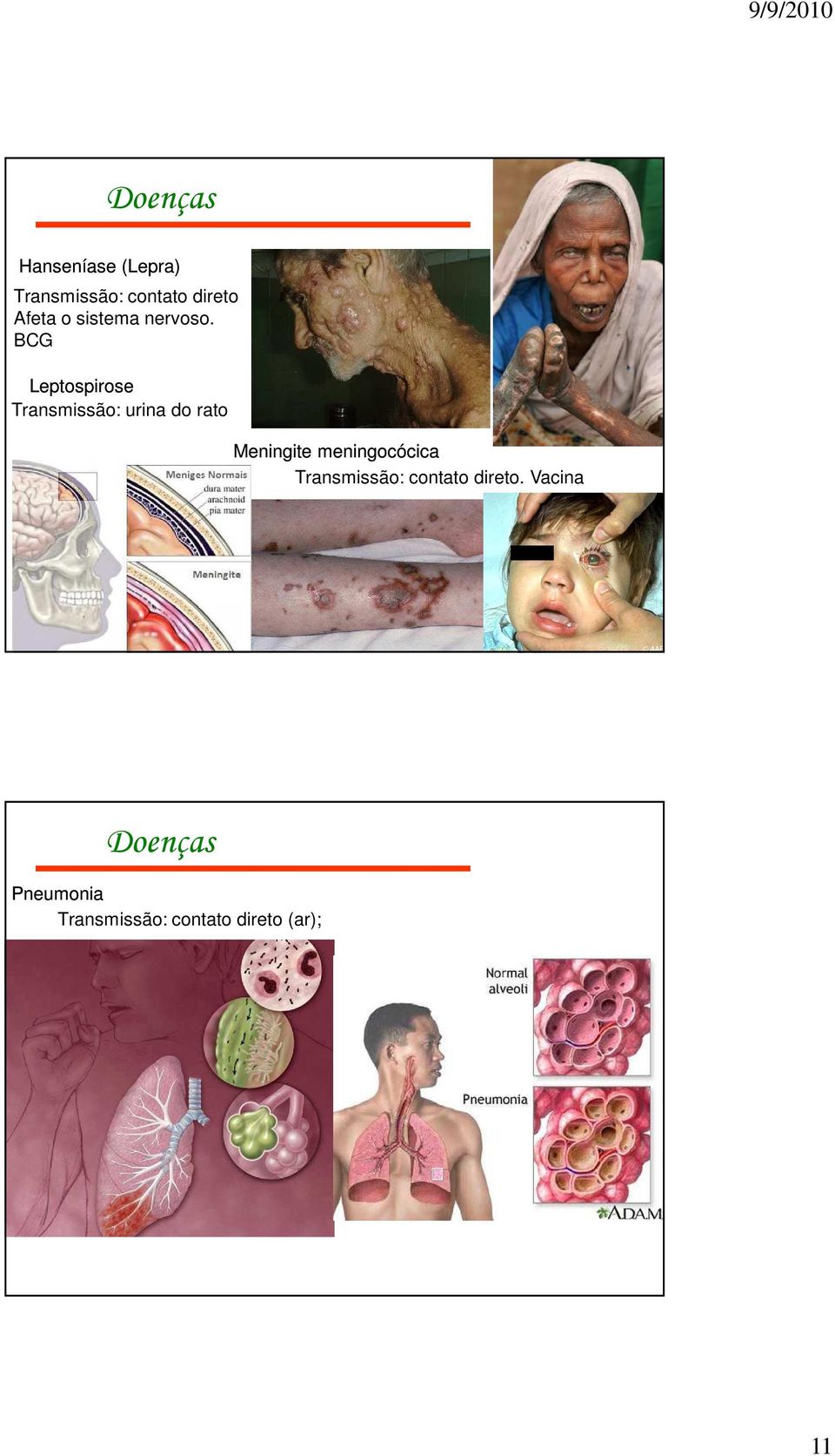 BCG Leptospirose Transmissão: urina do rato Meningite