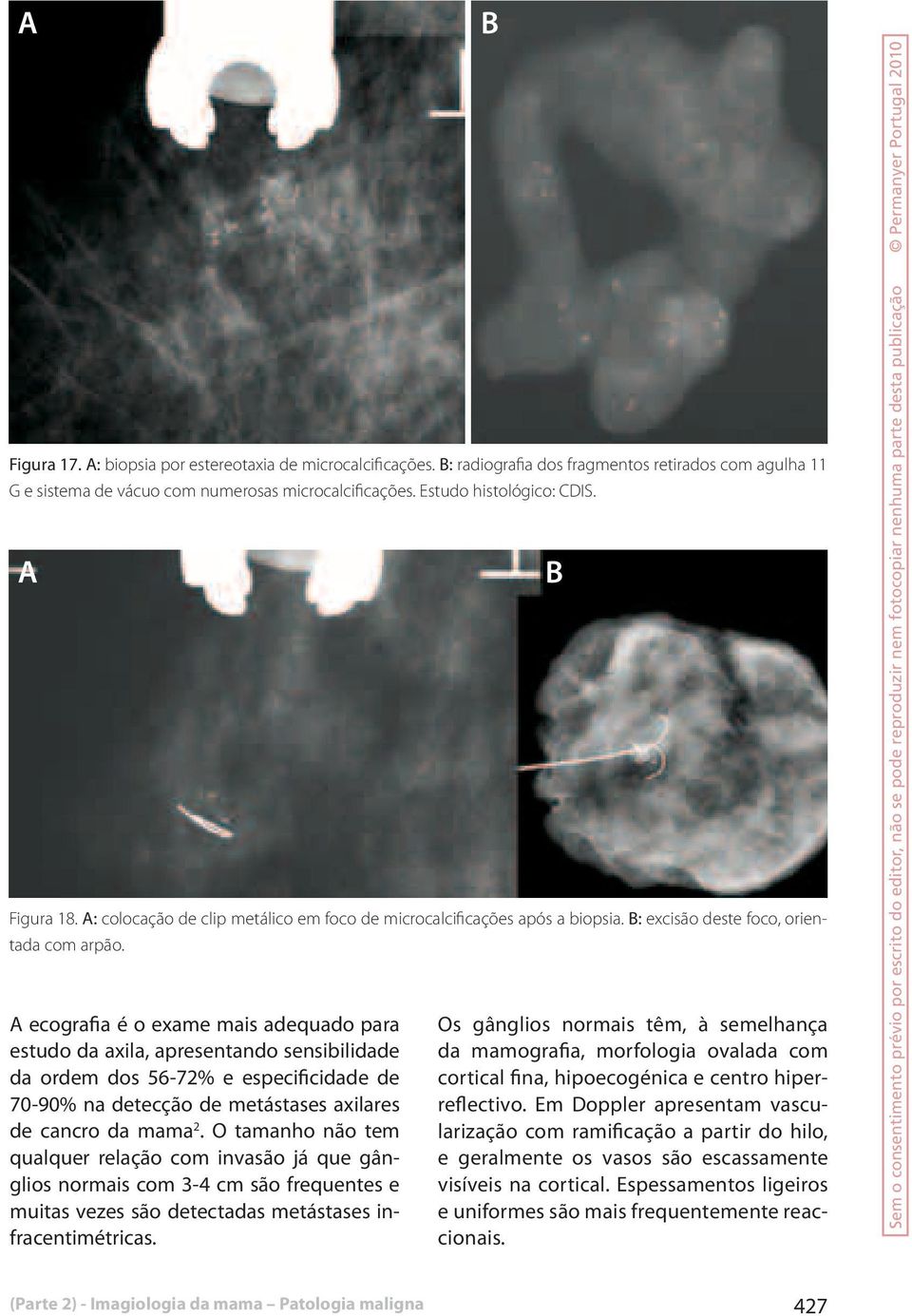 A ecografia é o exame mais adequado para estudo da axila, apresentando sensibilidade da ordem dos 56-72% e especificidade de 70-90% na detecção de metástases axilares de cancro da mama 2.