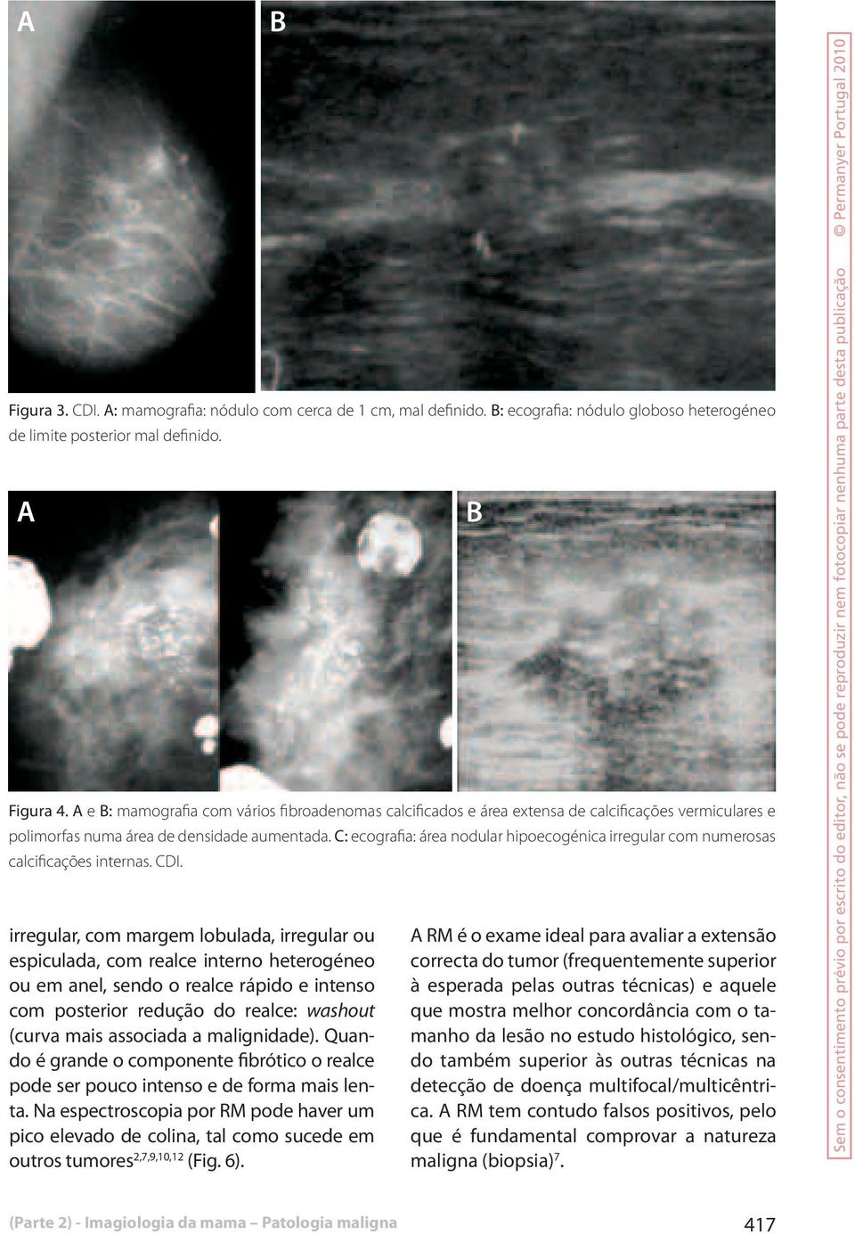 C: ecografia: área nodular hipoecogénica irregular com numerosas calcificações internas. CDI.