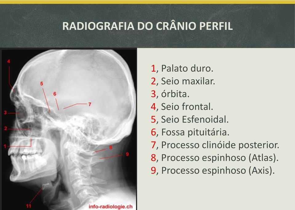 5, Seio Esfenoidal. 6, Fossa pituitária.