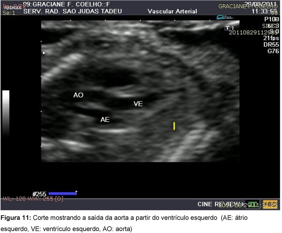 ventrículo esquerdo (AE: átrio