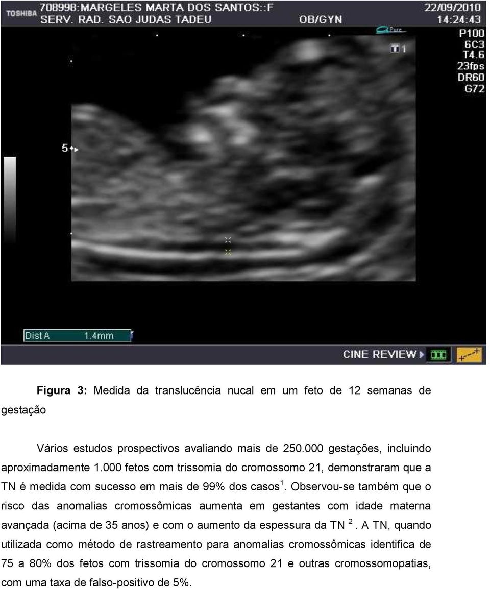 Observou-se também que o risco das anomalias cromossômicas aumenta em gestantes com idade materna avançada (acima de 35 anos) e com o aumento da espessura da TN 2.