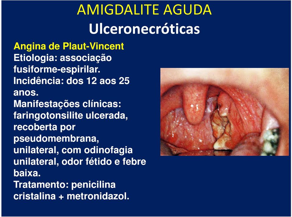 Manifestações clínicas: faringotonsilite ulcerada, recoberta por pseudomembrana,