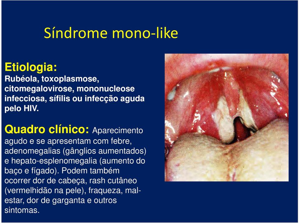 Quadro clínico: Quadro clínico: Aparecimento agudo e se apresentam com febre, adenomegalias (gânglios