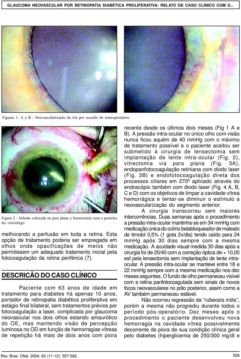 DESCRICÃO DO CASO CLÍNICO Paciente com 63 anos de idade em tratamento para diabetes há apenas 10 anos, portador de retinopatia diabética proliferativa em estágio final bilateral, sem tratamentos