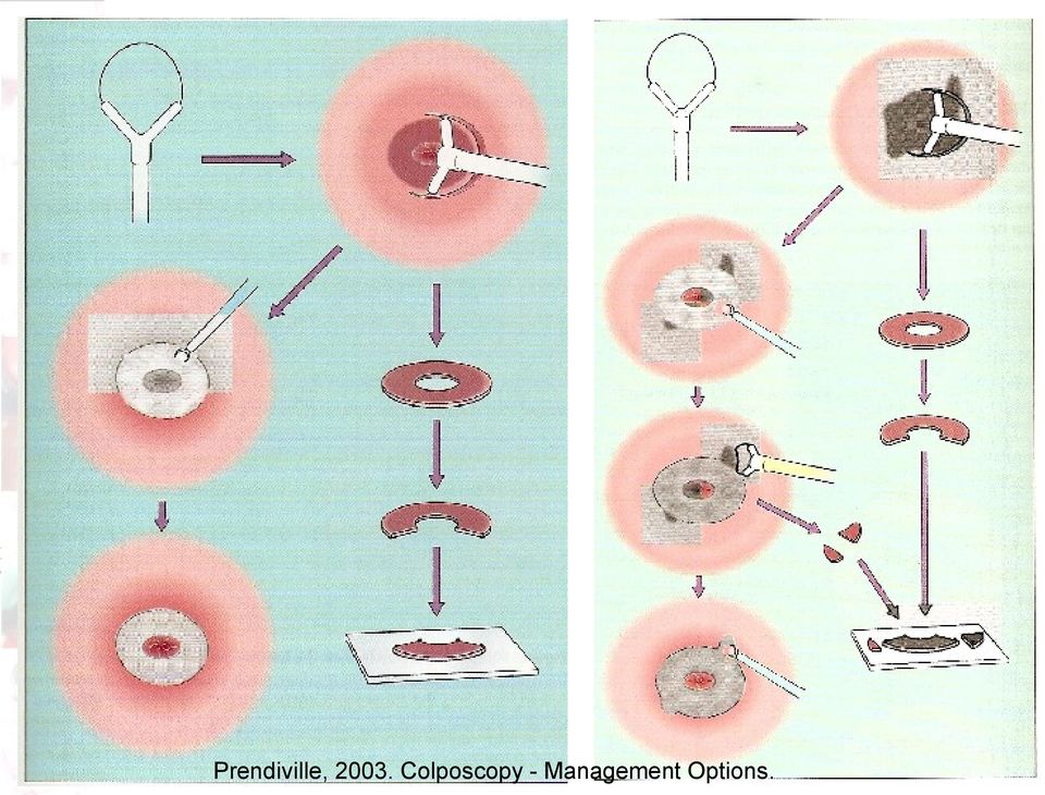 Colposcopy -