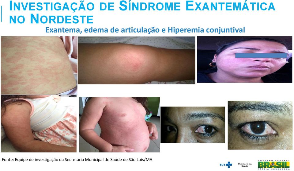 Hiperemia conjuntival Fonte: Equipe de