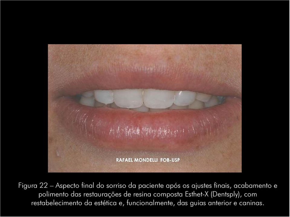 de resina composta Esthet-X (Dentsply), com