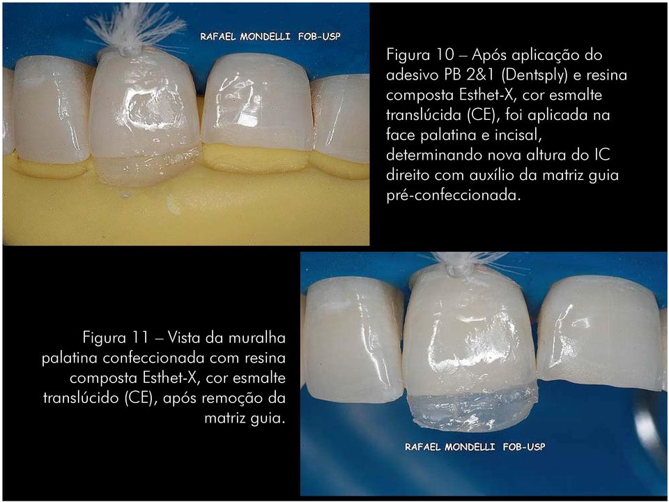 Figura 10 Após aplicação do adesivo PB 2&1 (Dentsply) e resina composta Esthet-X, cor esmalte