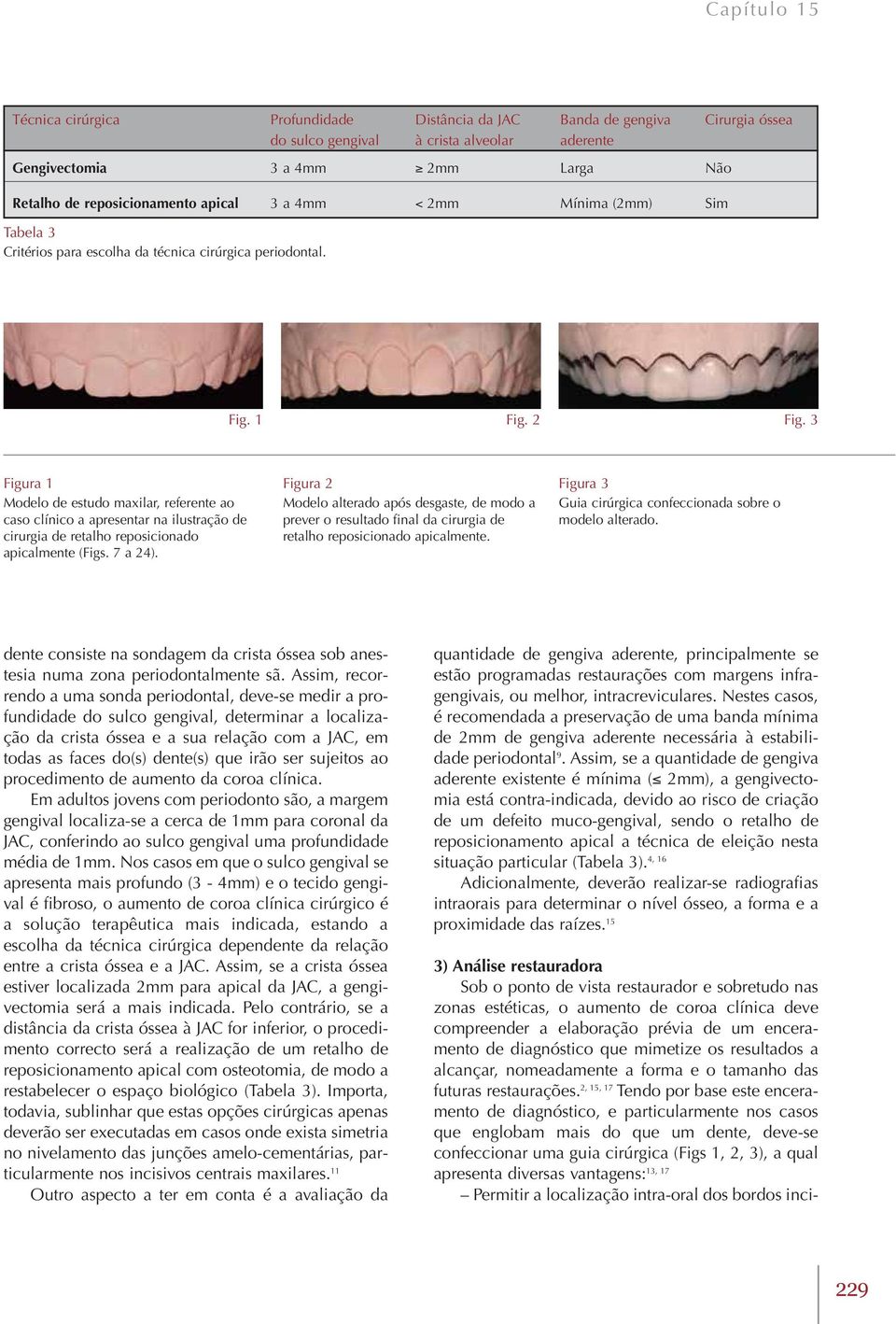 3 Figura 1 Modelo de estudo maxilar, referente ao caso clínico a apresentar na ilustração de cirurgia de retalho reposicionado apicalmente (Figs. 7 a 24).