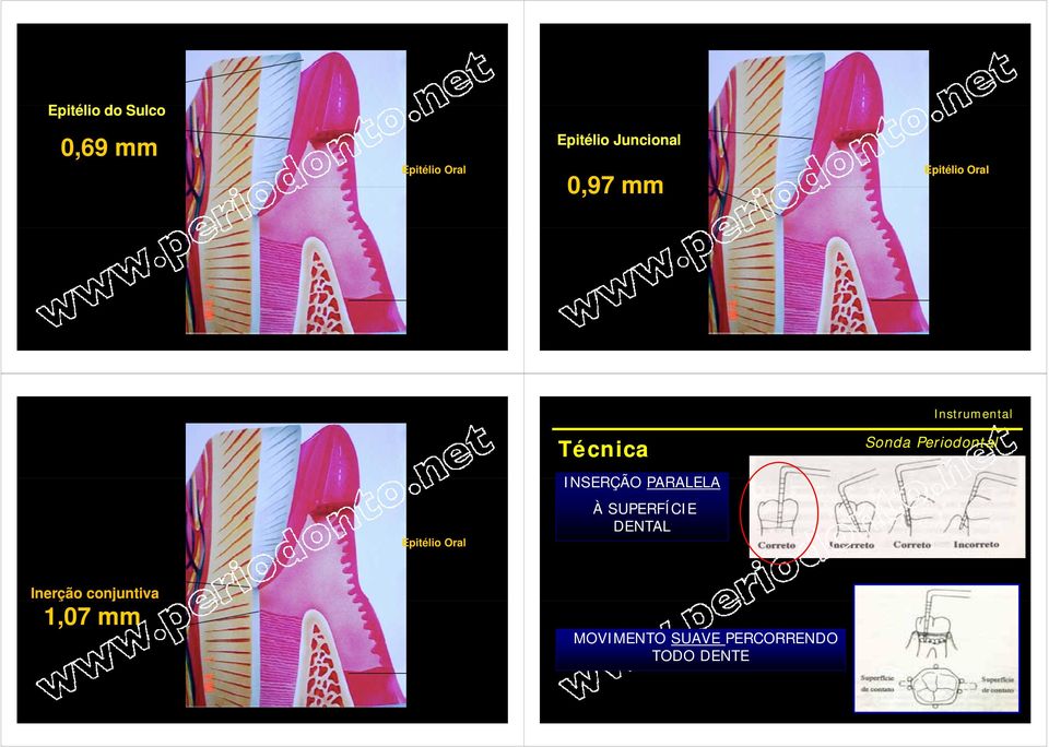 Epitélio Oral À SUPERFÍCIE DENTAL Inerção conjuntiva 1,07 mm