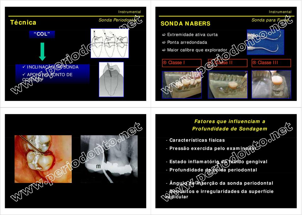 Profundidade de Sondagem - Características físicas - Pressão exercida pelo examinador - Estado inflamatório do tecido