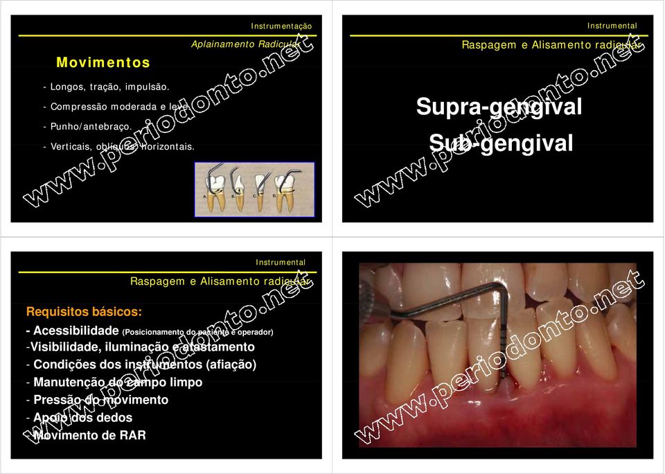 Supra-gengival g Sub-gengival Raspagem e Alisamento radicular Requisitos básicos: - Acessibilidade (Posicionamento i do