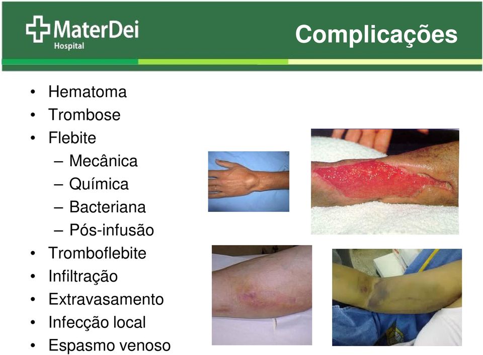 Pós-infusão Tromboflebite Infiltração