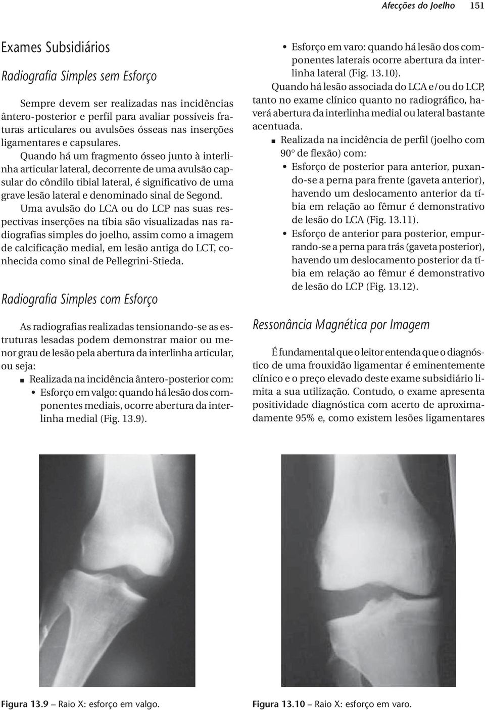 Quando há um fragmento ósseo junto à interlinha articular lateral, decorrente de uma avulsão capsular do côndilo tibial lateral, é significativo de uma grave lesão lateral e denominado sinal de