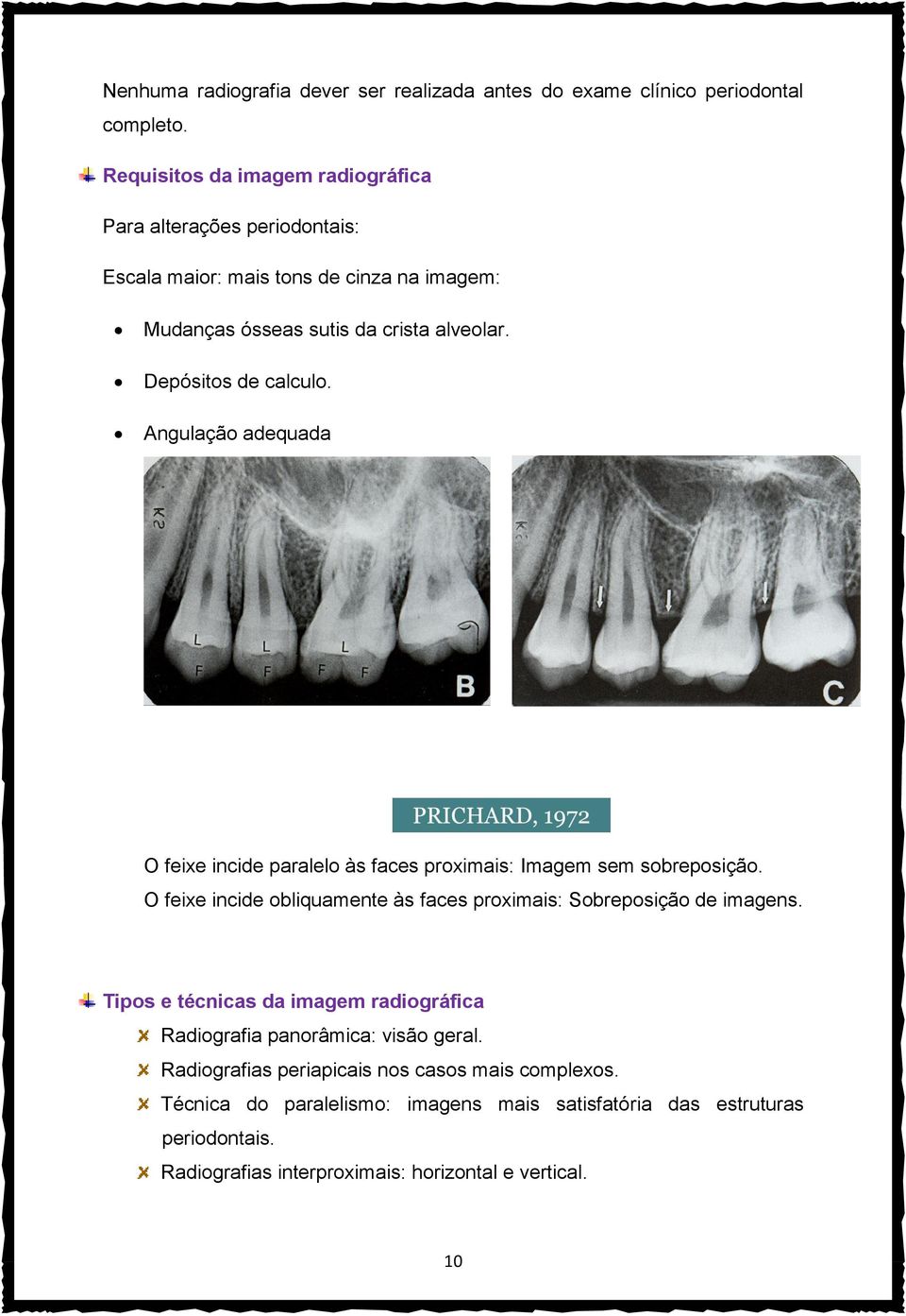 Depósitos de calculo. Angulação adequada O feixe incide paralelo às faces proximais: Imagem sem sobreposição.