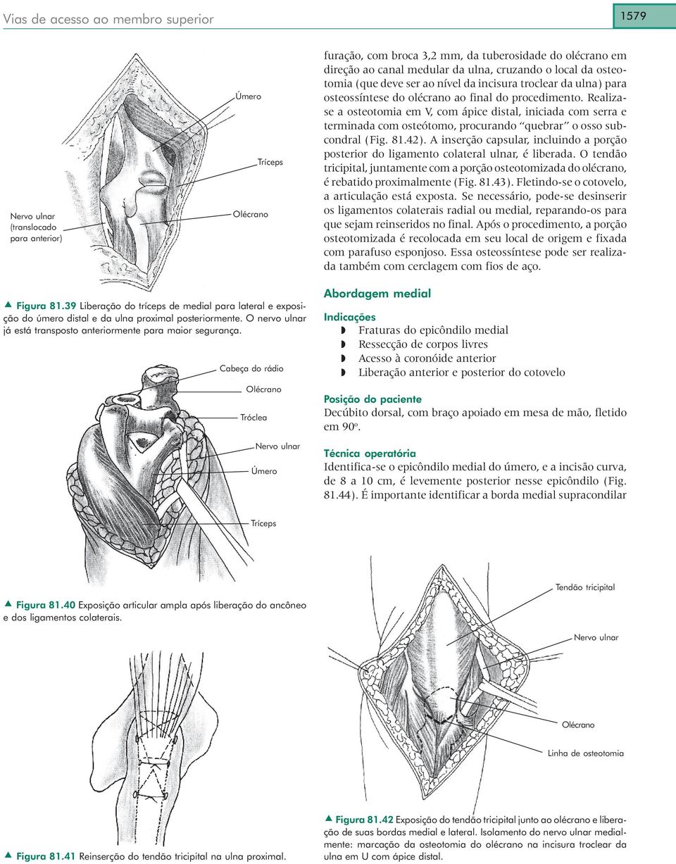 Realizase a osteotomia em V, com ápice distal, iniciada com serra e terminada com osteótomo, procurando quebrar o osso subcondral (Fig. 81.42).