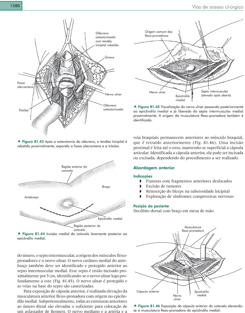 A origem da musculatura flexo-pronadora também é identificada. Figura 81.43 Após a osterotomia do olécrano, o tendão tricipital é rebatido proximalmente, expondo a fossa olecraniana e a tróclea.