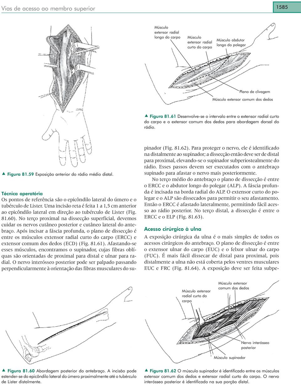 Os pontos de referência são o epicôndilo lateral do úmero e o tubérculo de Lister. Uma incisão reta é feita 1 a 1,5 cm anterior ao epicôndilo lateral em direção ao tubérculo de Lister (Fig. 81.60).